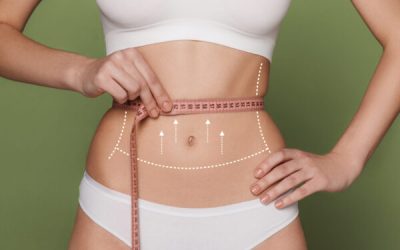 Women belly with the drawing arrows. The cellulite removal plan. White markings on young woman body preparing for plastic surgery. Concept of slimming, liposuction, strand lifting